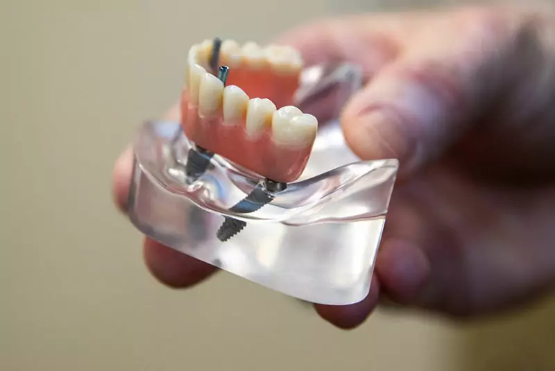 A close-up of a hand holding a dental implant model. The model shows artificial teeth secured to a clear base with screws, illustrating dental implant structure.