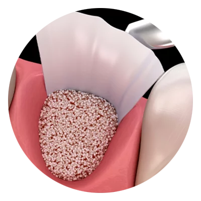 Close-up illustration of dental surgery, showing bone grafting material in a tooth socket with gum tissue retracted. Metallic tool stands nearby, set against a black background.