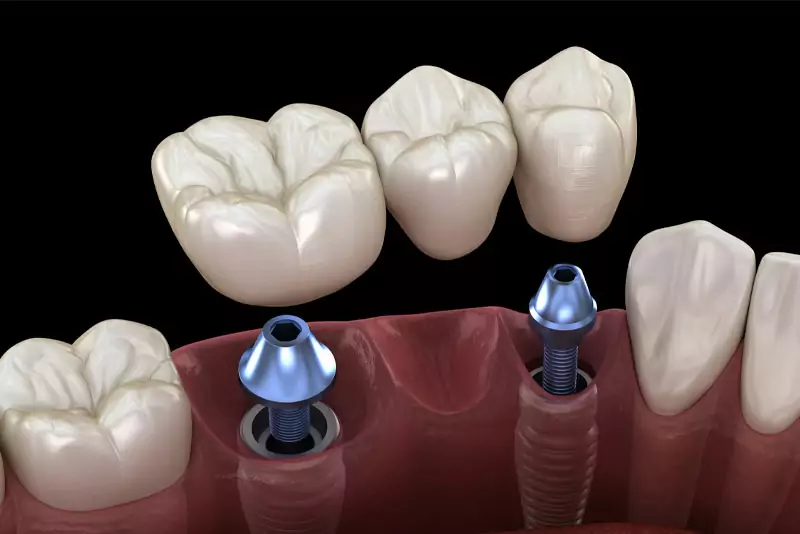 Illustration of dental implants in a gum model. Two metal implants are visible with crowns above, showing the process of tooth replacement.