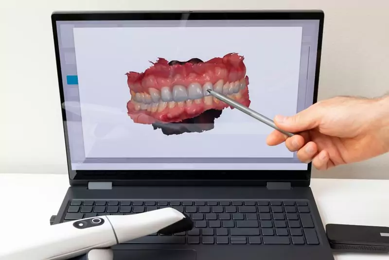A laptop displays a 3D model of a dental impression. A hand uses a stylus to point at teeth on the screen. A dental scanner is visible in the foreground.