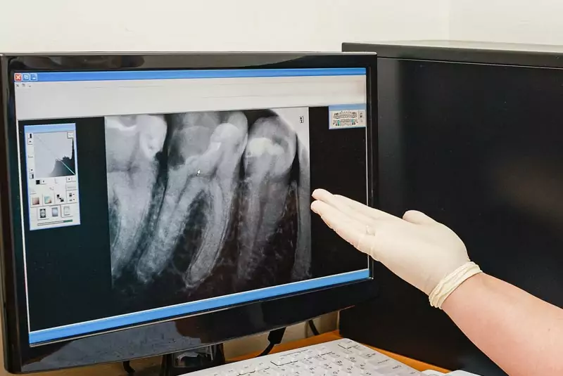 A gloved hand points at a dental X-ray on a computer screen, showing detailed images of teeth roots. The setting is clinical and analytical.