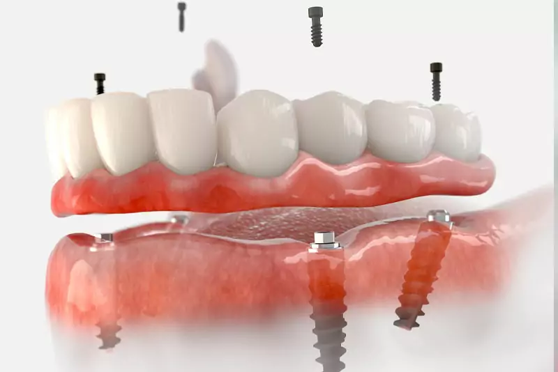 Illustration of dental implants with a row of artificial teeth above the gum line. Metal screws show how the implants anchor into the jawbone.