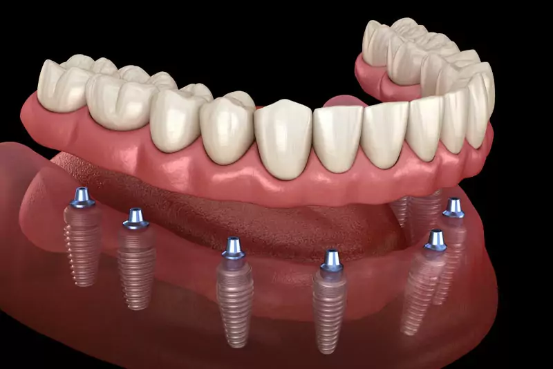 3D rendering of a dental prosthesis, showing an upper arch of teeth mounted on six dental implants in a curved pink gum base against a black background.