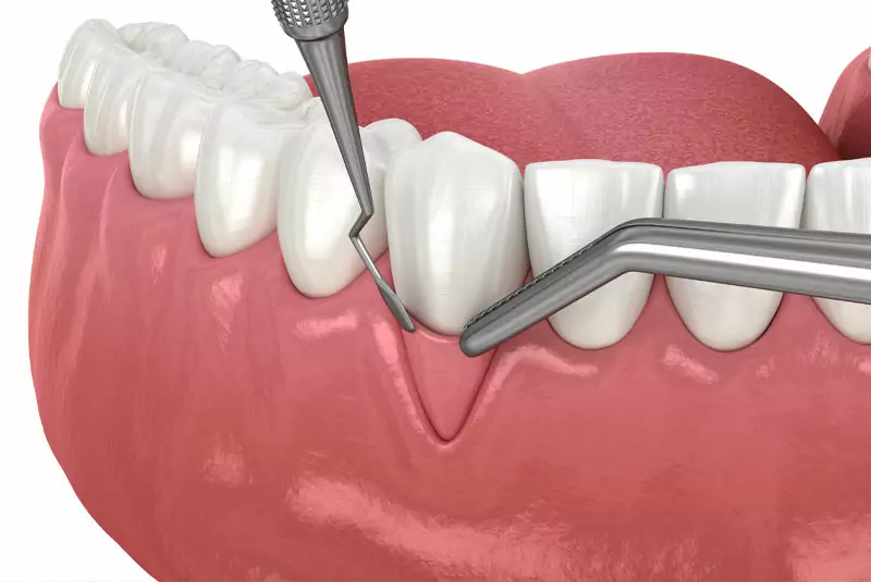 3D rendering of dental scaling shows metal instruments cleaning plaque from teeth near the gumline, emphasizing oral hygiene and dental care.