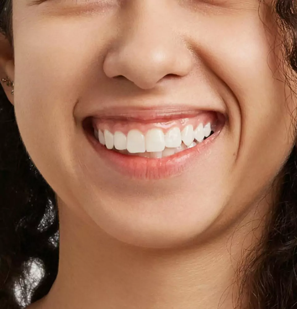 Close-up of a smiling person showing bright white teeth. The expression conveys happiness. Curly hair is visible on the side.