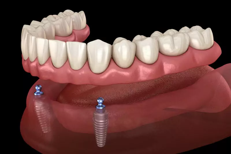 3D illustration of a lower denture supported by dental implants. The gums and teeth appear natural, with two metal implants visible in the jaw.