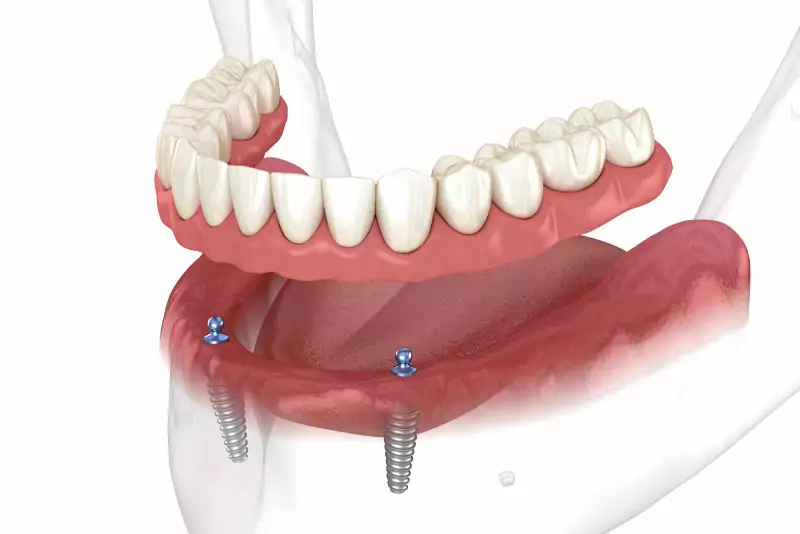 3D illustration of a removable denture with metal implants, showcasing a full set of lower teeth anchored by two implants in the jaw.