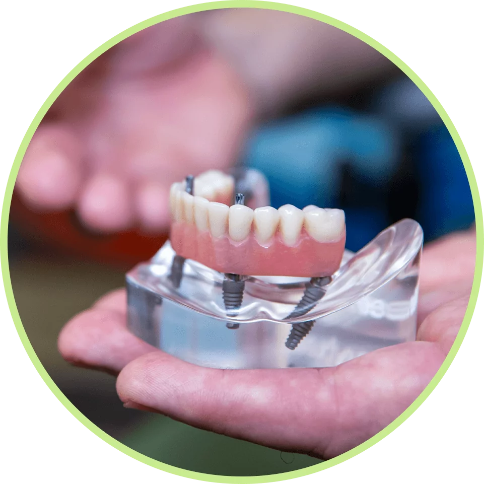 Close-up of a hand holding a dental implant model with artificial teeth attached to metal screws. The model conveys professionalism and precision.
