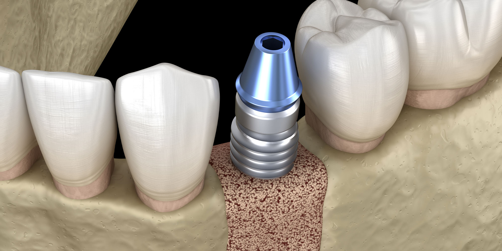 Illustration of a dental implant in the jaw, between natural teeth. The metal implant is embedded in the bone, showing a step in dental restoration.
