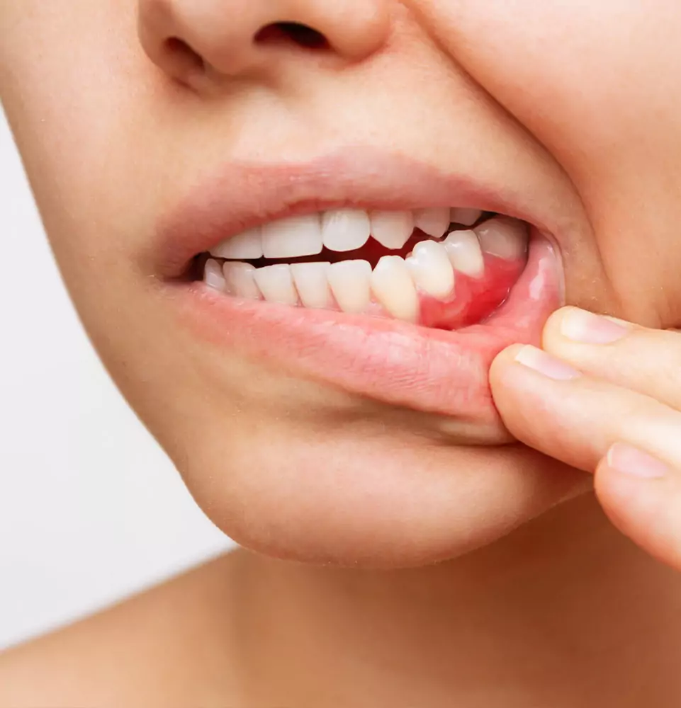 Close-up of a person pulling down their lower lip to reveal a swollen, red gum, indicating irritation or gingivitis. The expression suggests discomfort.