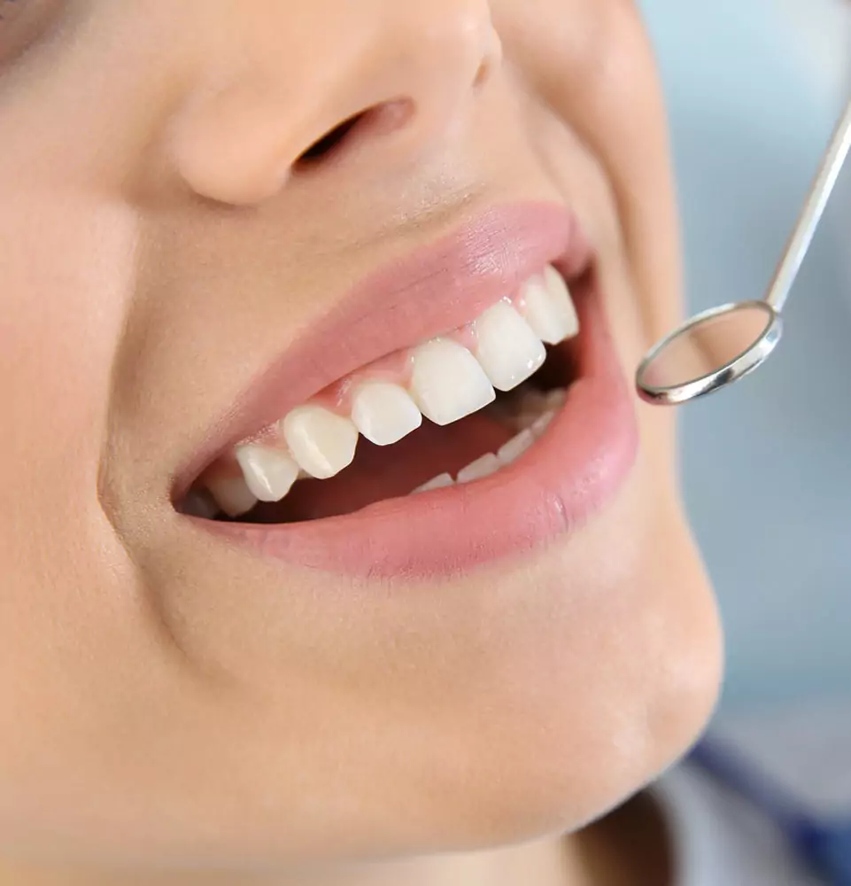 Close-up of a smiling person showing clean, healthy teeth during a dental check-up, with a dental mirror reflecting light nearby.