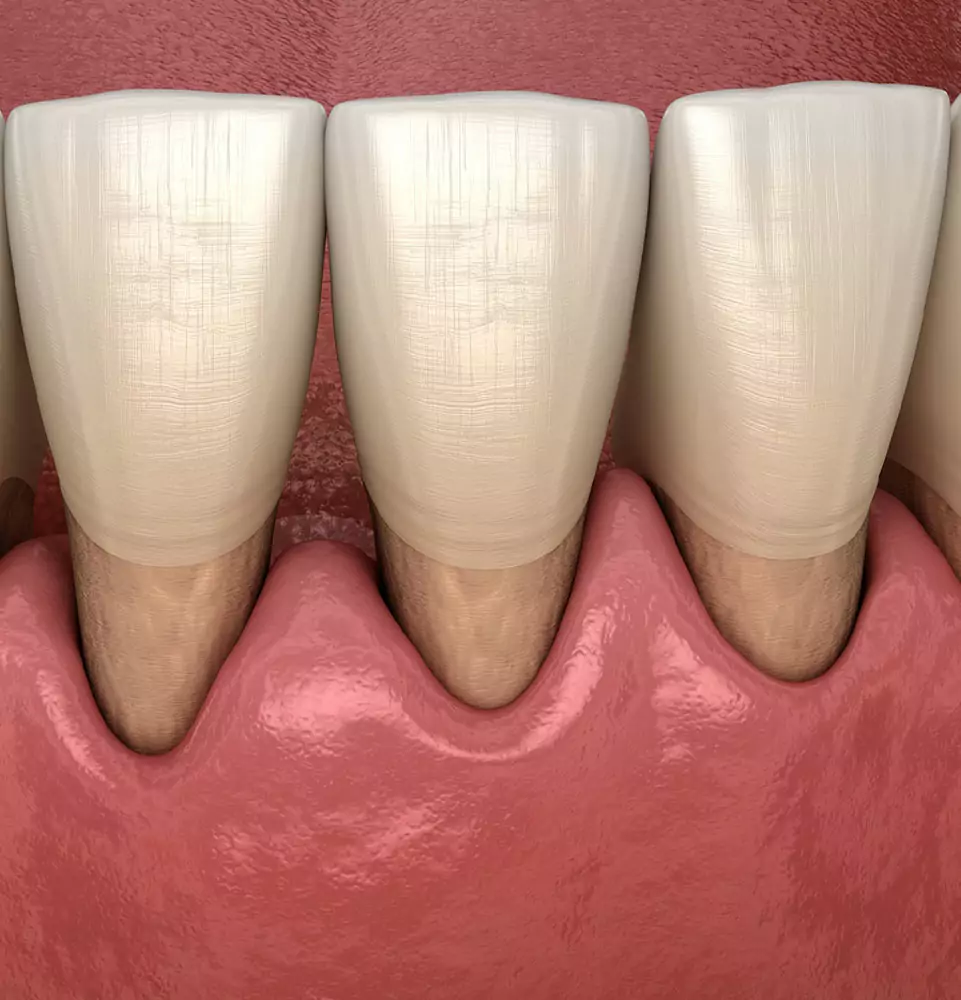 Close-up illustration of three teeth with exposed roots due to receding gums. The gums appear red and uneven, suggesting dental issues.
