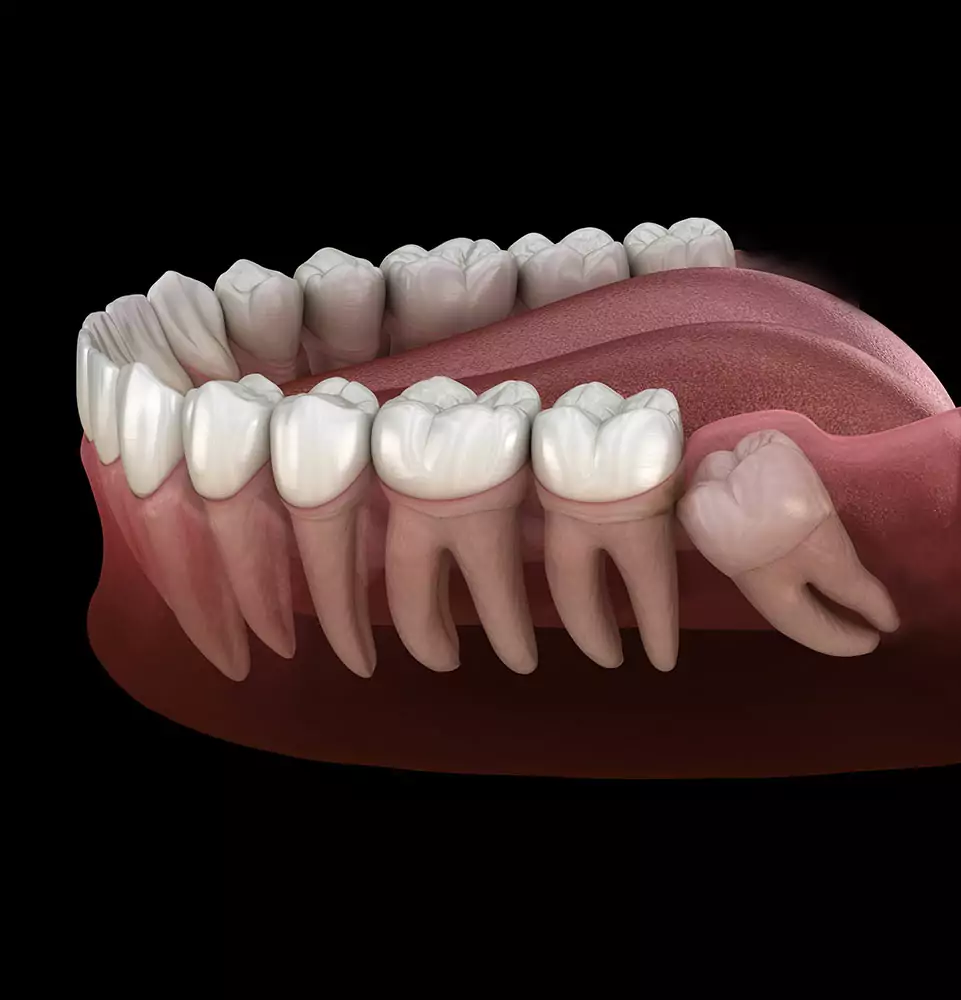Illustration of a human jaw showing teeth and gums, with an impacted wisdom tooth pressing against the last molar. The background is black.
