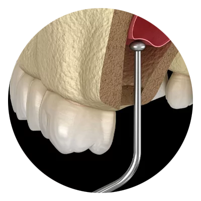Illustration of a dental examination shows a metal probe measuring the depth of gum pockets beside a tooth, highlighting oral health assessment.