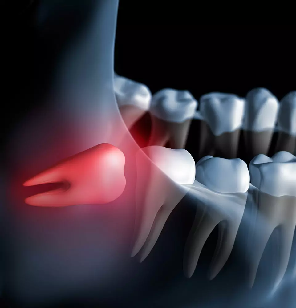 X-ray illustration of a human jaw highlighting an impacted wisdom tooth. The tooth is shown in red, indicating pain or inflammation, with a dark background.