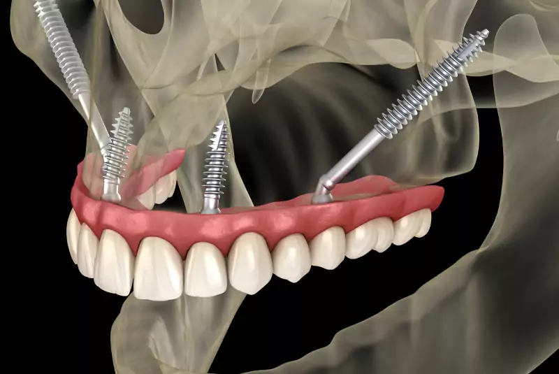 Illustration of dental implants in a jaw with four metal screws securing a full set of upper teeth. The transparent jawbone highlights implant placement.